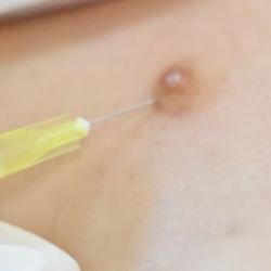 Vücudun Hangi Bölgesindeki Benler Tehlikelidir?