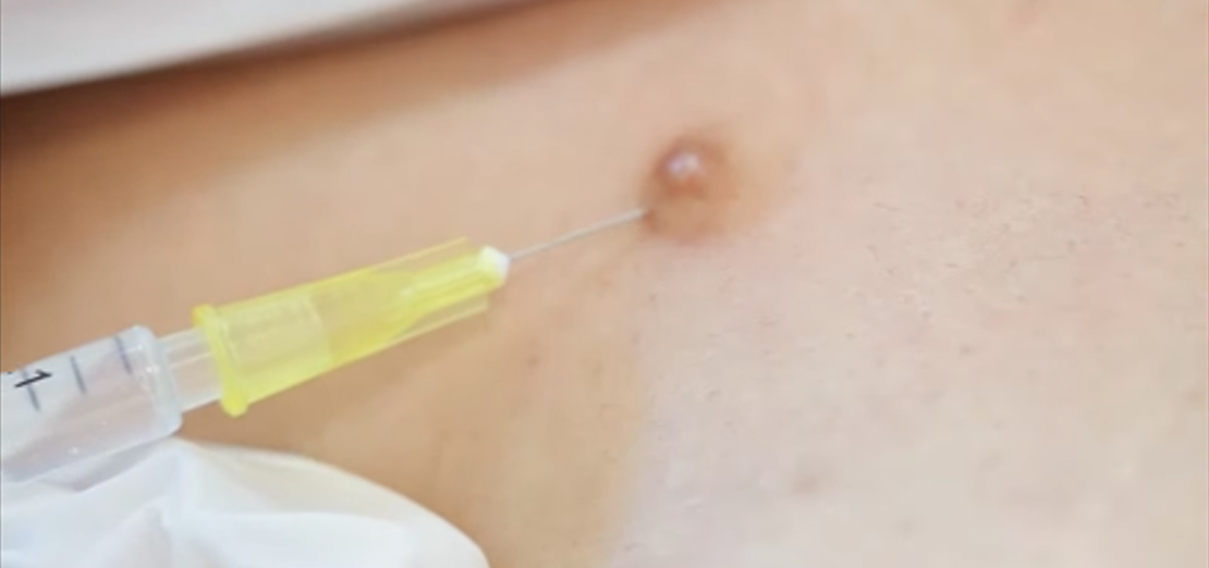 Vücudun Hangi Bölgesindeki Benler Tehlikelidir?